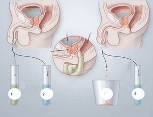 prostatic massage