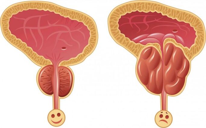 healthy and inflamed prostate with prostatitestat