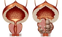 Healthy and junk food prostate