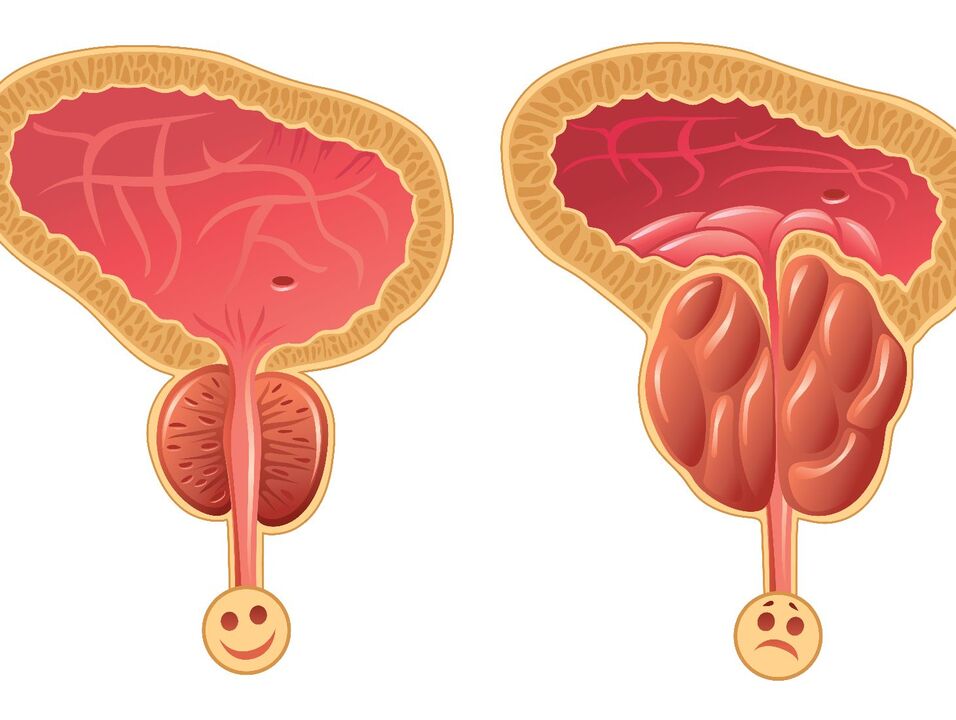 Healthy prostate gland and prostate congestion with congestive prostatitis