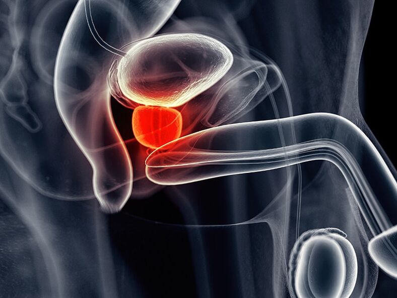 Inflammation of the prostate gland accompanying chronic prostatitis